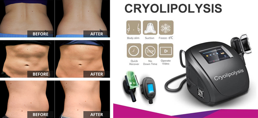 Non-Invasive Liposuction, freezing fat cells, Stomach Liposuction before  and after